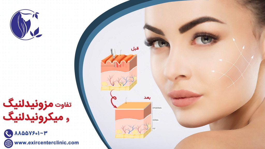 تفاوت میان میکرونیدلینگ و مزونیدلینگ