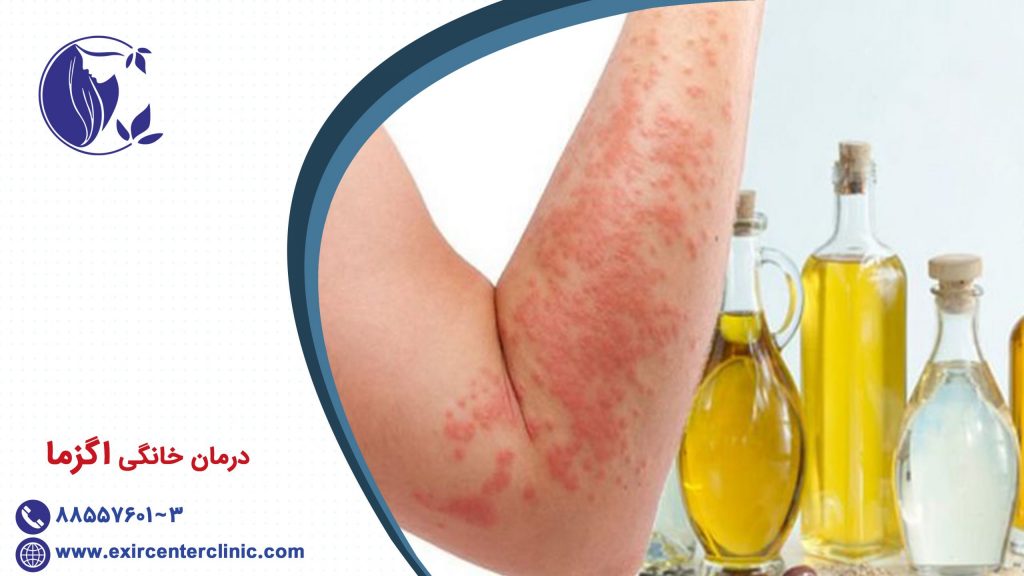 درمان خانگی اگزما