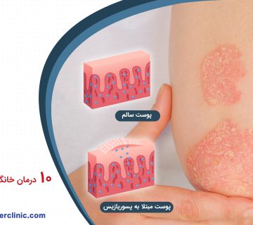 درمان خانگی پسوریازیس