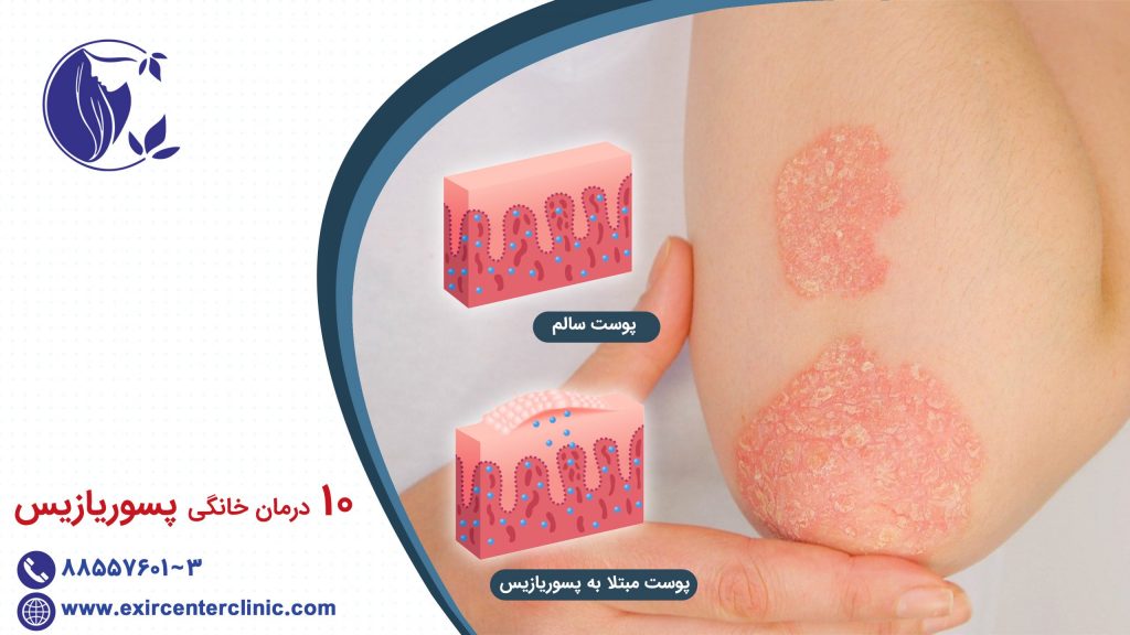 درمان خانگی پسوریازیس