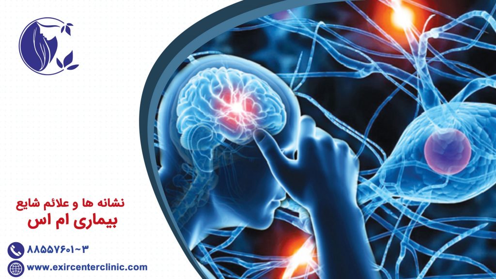 نشانه ها و علائم شایع بیماری ام اس