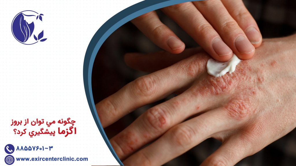 چگونه مي توان از بروز اگزما پيشگيري كرد؟
