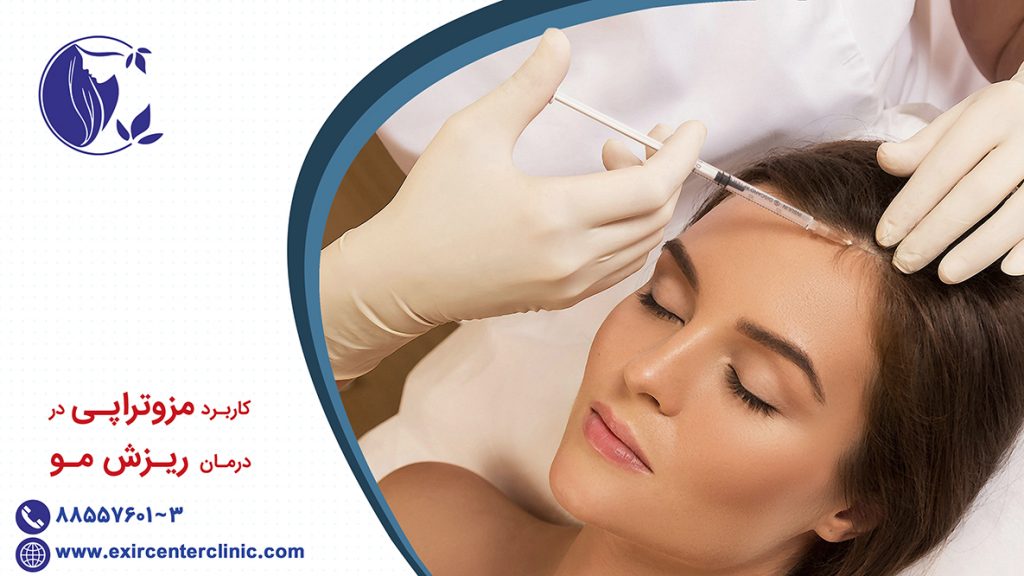 مزوتراپی ریزش مو 