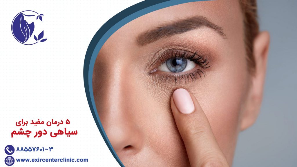 5 درمان مفید برای سیاهی دور چشم