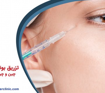 تزریق بوتاکس برای رفع چین و چروک دور چشم