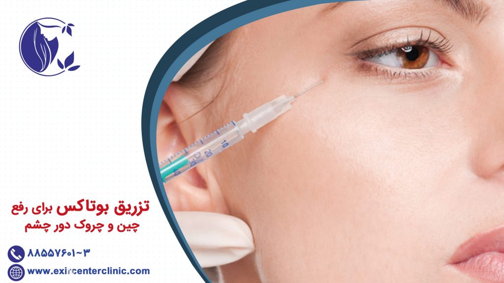 تزریق بوتاکس برای رفع چین و چروک دور چشم