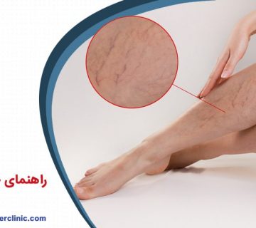 راهنمای جامع واریس