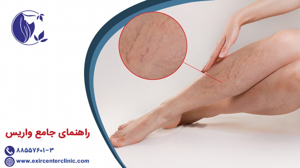 راهنمای جامع واریس