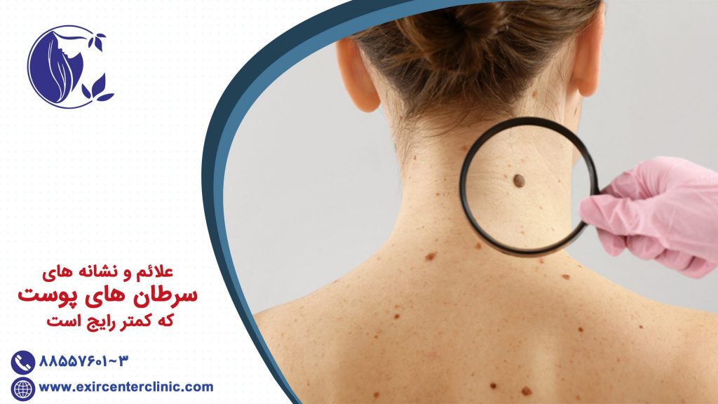 علائم و نشانه های سرطان پوست که کمتر رایج است