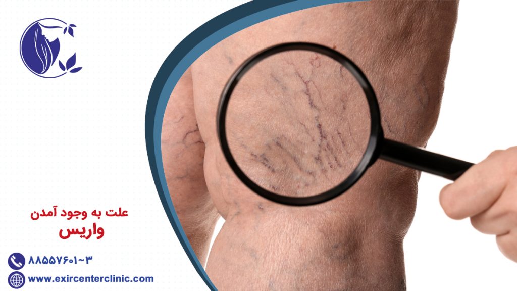 علت به وجود آمدن واریس