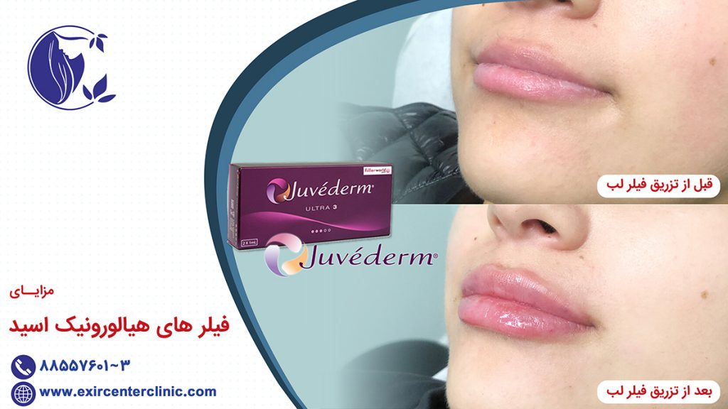 مزایای فیلر های هیالورونیک اسید