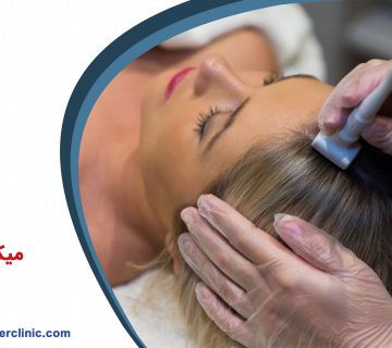 میکرونیدلینگ برای ریزش مو