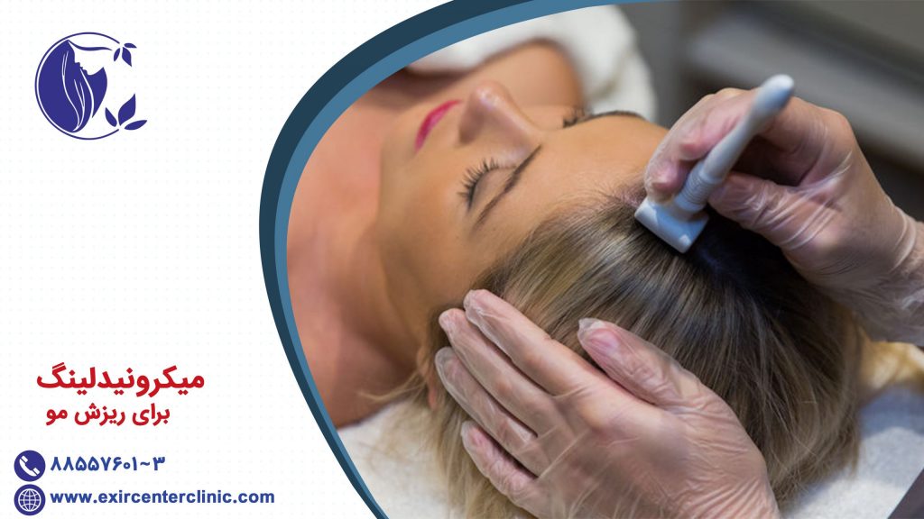 میکرونیدلینگ برای ریزش مو