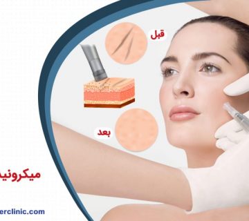 میکرونیدلینگ میکرونیدلینگ چیست؟
