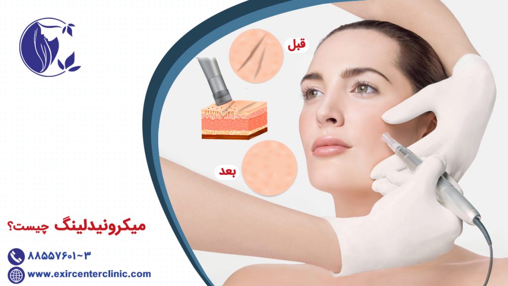 میکرونیدلینگ میکرونیدلینگ چیست؟