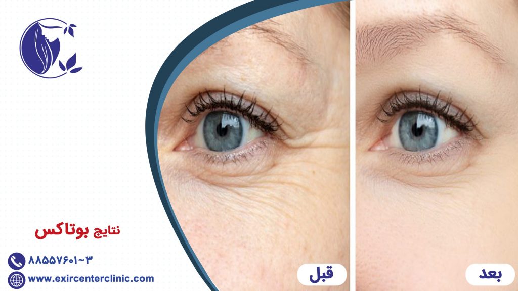 نتایج بوتاکس