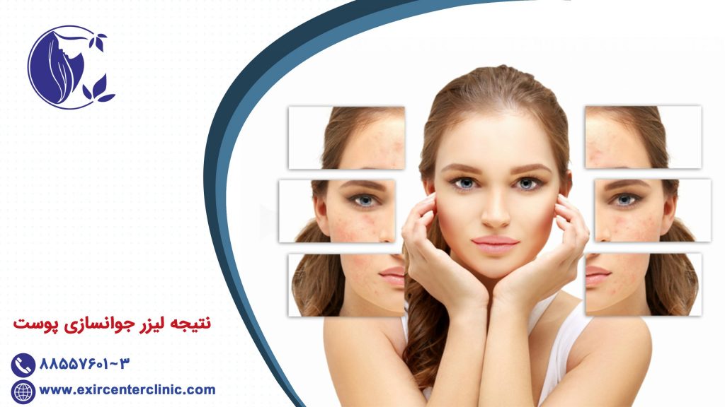 نتیجه لیزر جوانسازی پوست