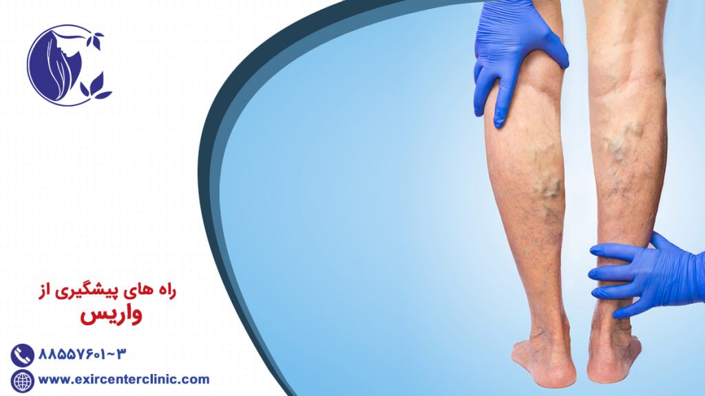 پیشگیری از واریس