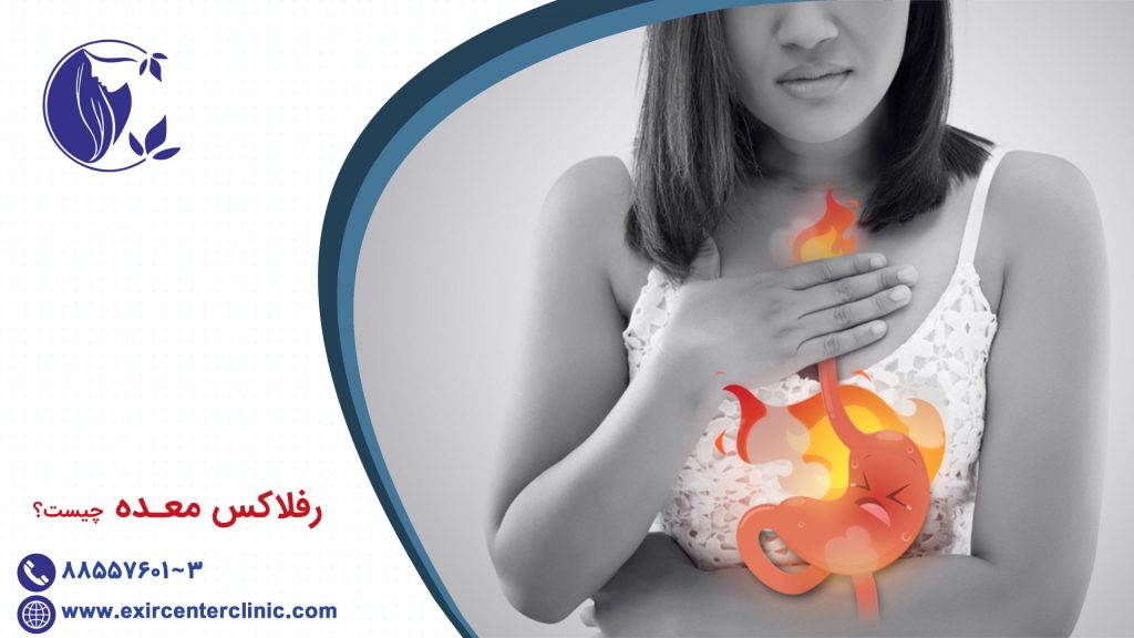 رفلاکس معده چیست؟