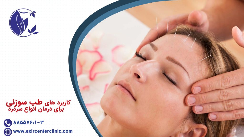 کاربرد های طب سوزنی برای انواع سردرد