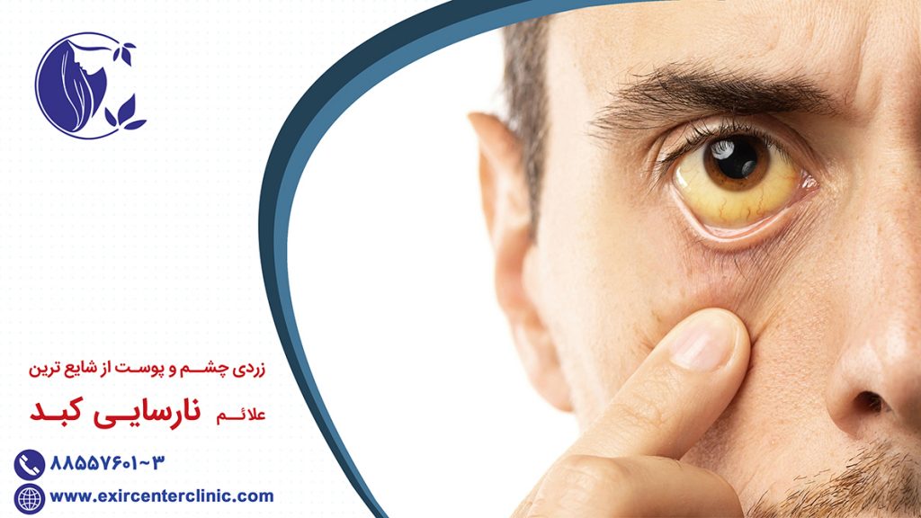 زردی چشم و نارسایی کبد 