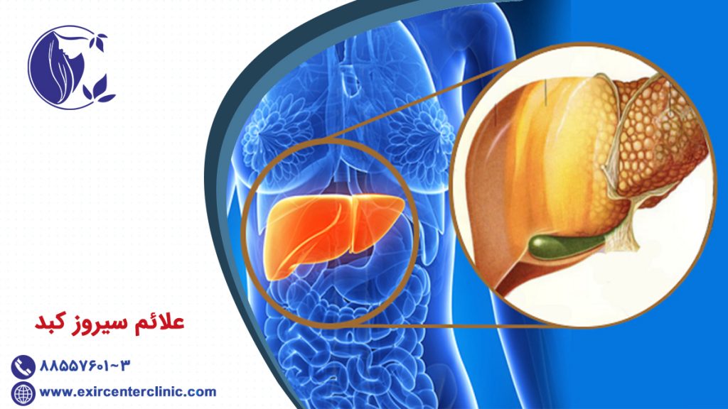 علائم سیروز
