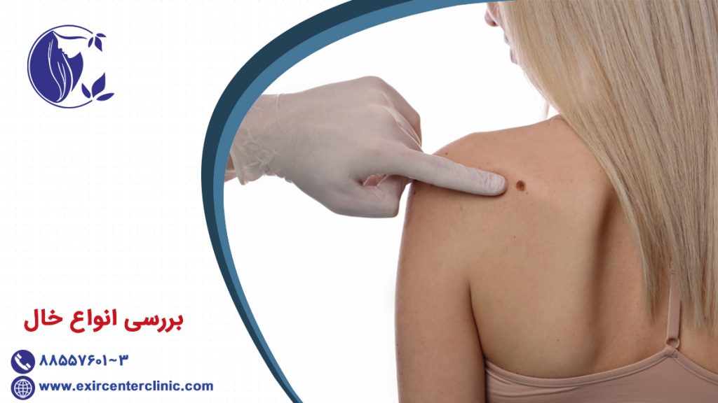 بررسی انواع خال