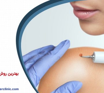 بهترین روش خال برداری