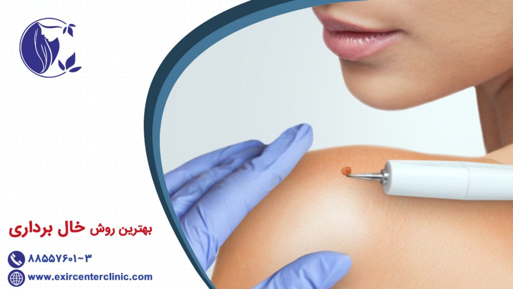 بهترین روش خال برداری