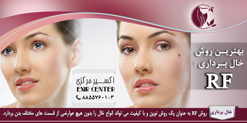 برداشت خال‌ 