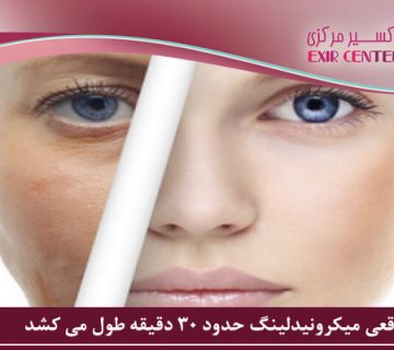 بهترین زمان میکرونیدلینگ