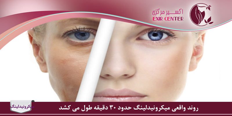 بهترین زمان میکرونیدلینگ