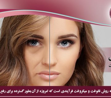 تزریق چربی به روش نانوفت و میکروفت