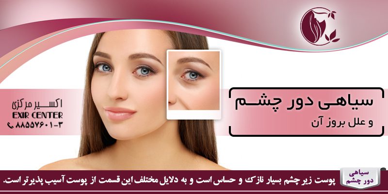 سیاهی دور چشم