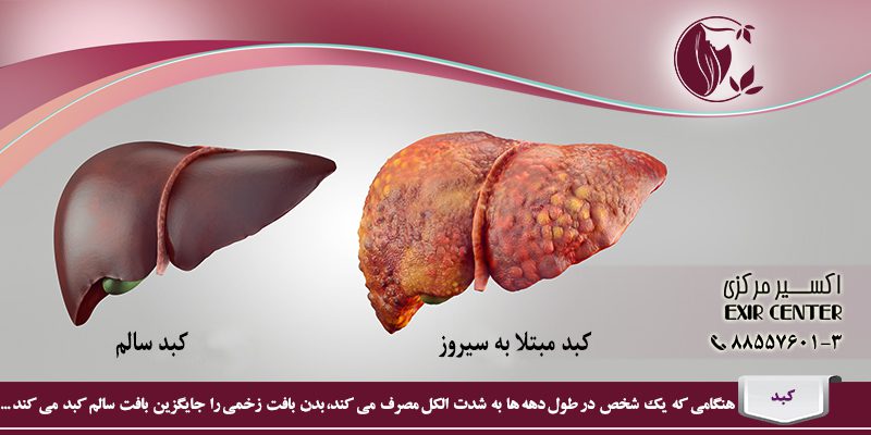 علت سیروز کبدی الکلی چیست