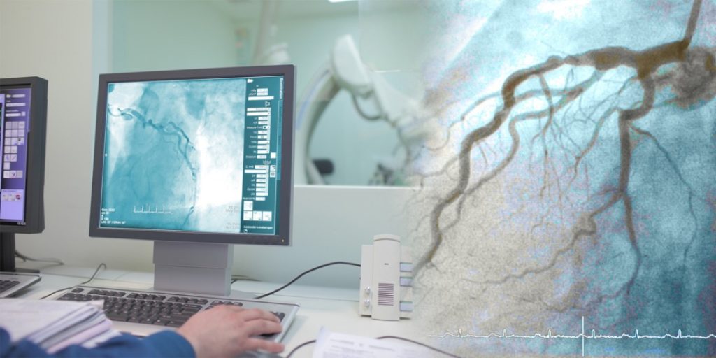 آنژیوگرافی