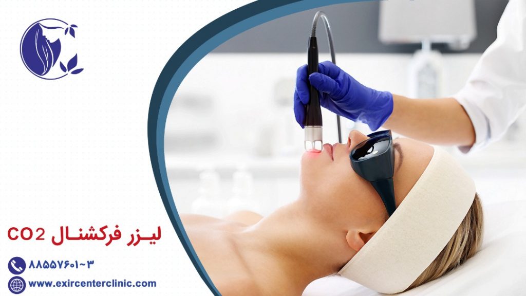 لیزر فرکشنال CO2