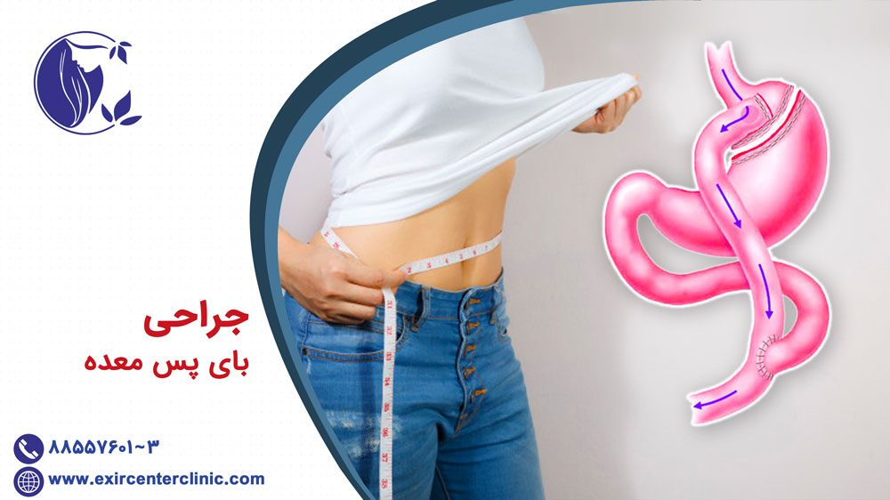 جراحی بای پس معده