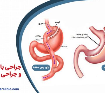جراحی بای پس معده و اسیلو