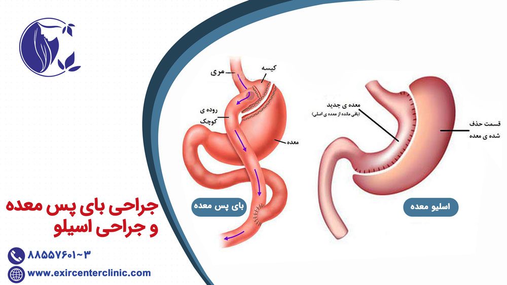 جراحی بای پس معده و اسیلو