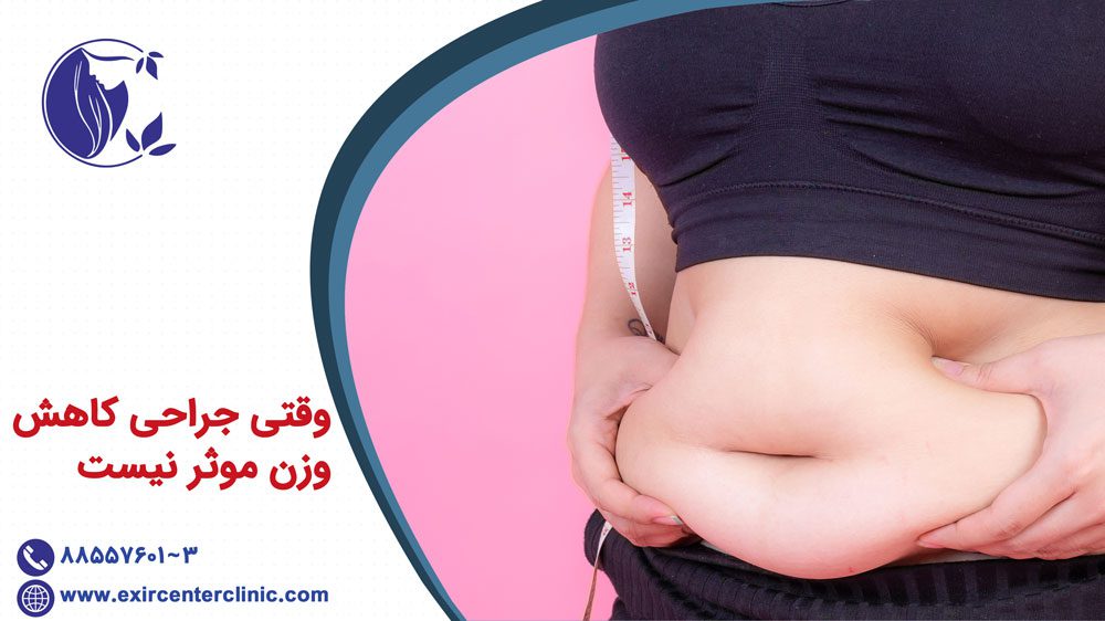 وقتی جراحی کاهش وزن موثر نیست