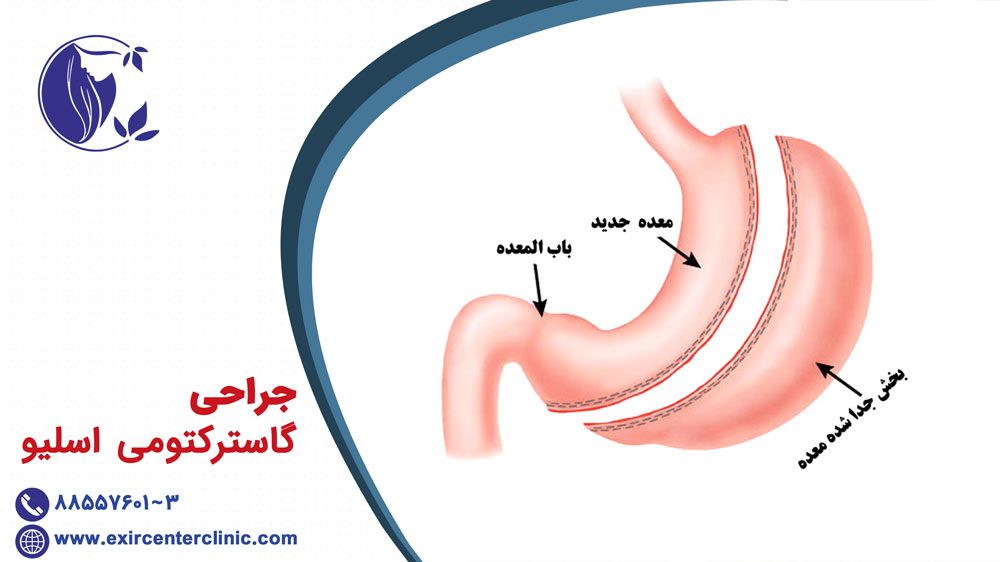 جراحی گاسترکتومی اسلیو