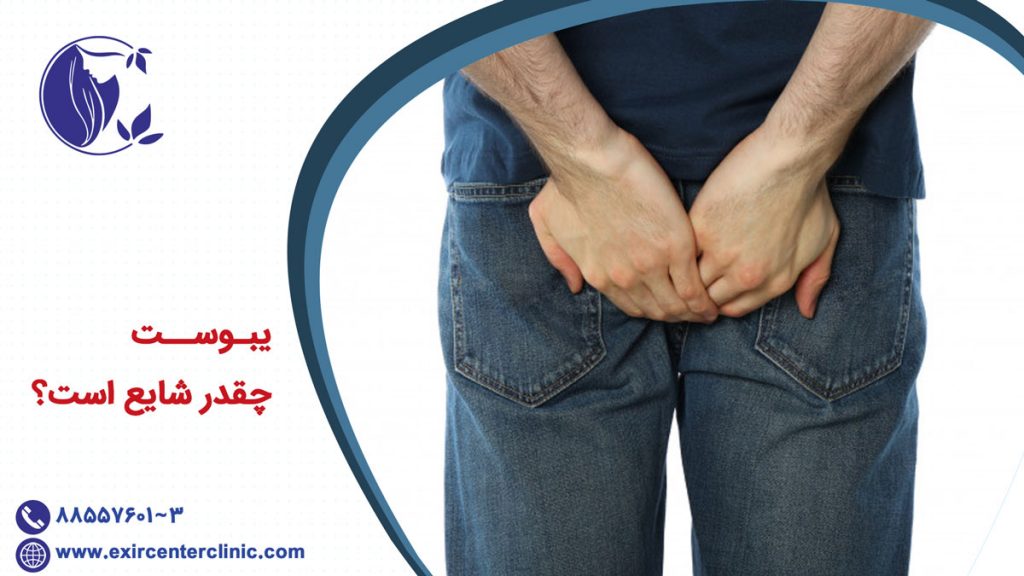 یبوست چقدر شایع است؟