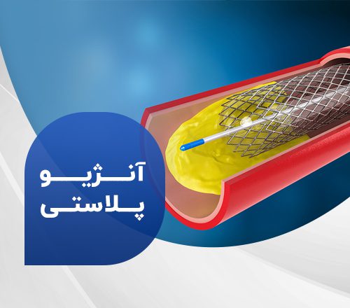 آنژیوپلاستی