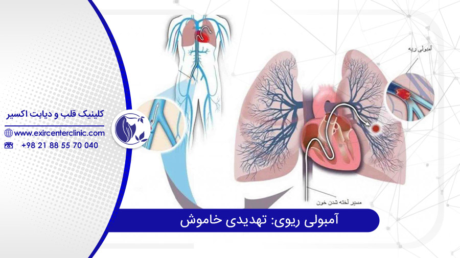 آمبولی ریوی