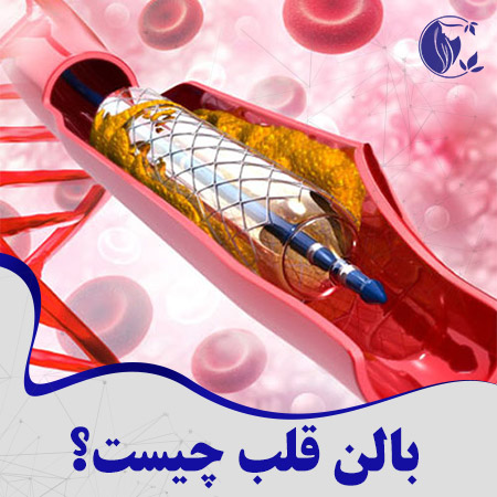 هزینه بالن قلب