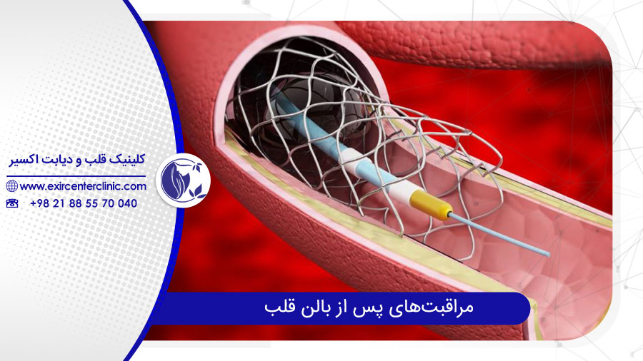 مراقبت‌های پس از بالون قلب