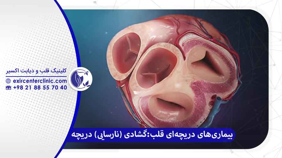 تنگی دریچه قلب