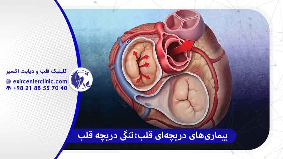 تنگی دریچه قلب
