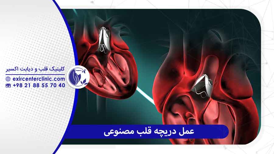 عمل دریچه قلب مصنوعی